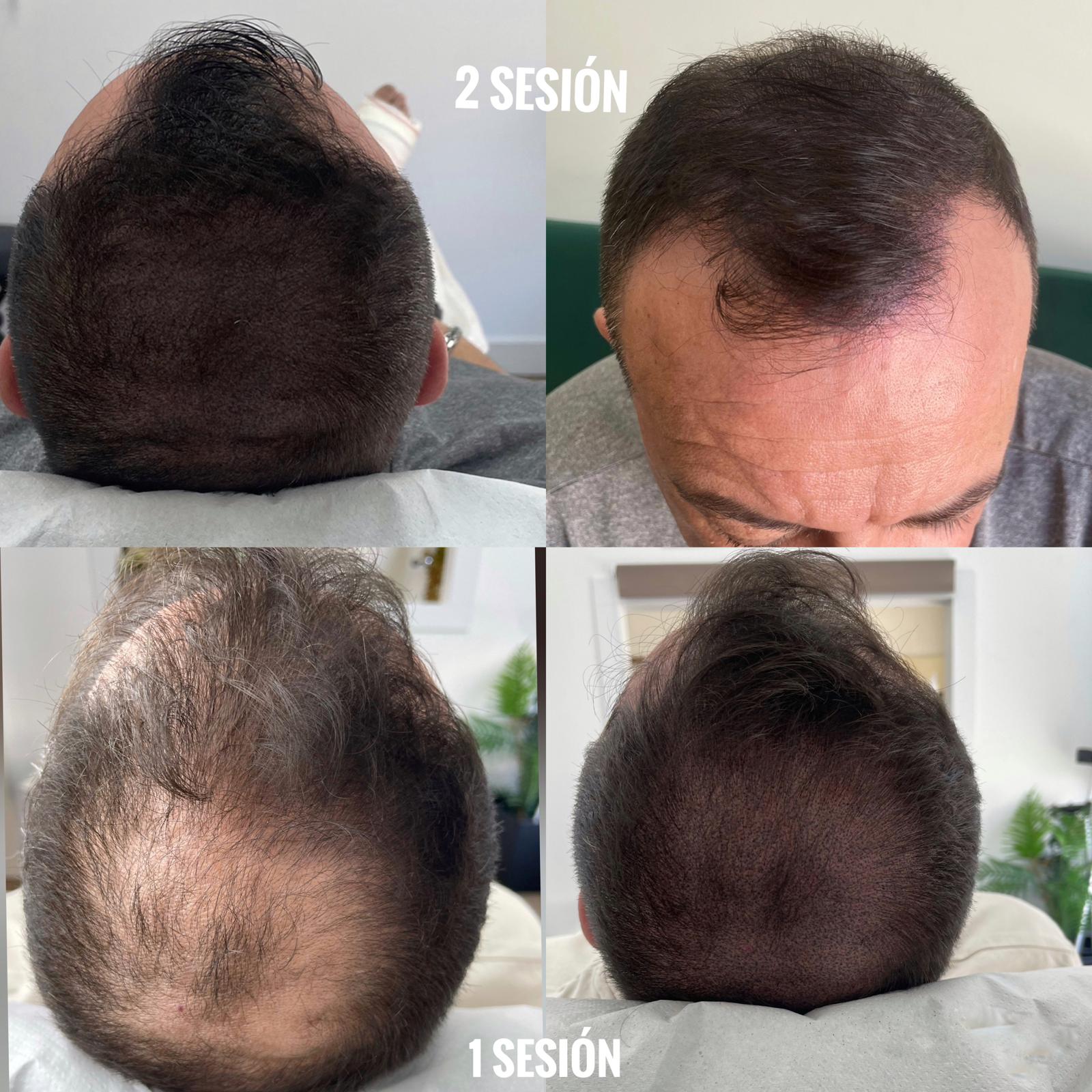 Tratamiento de densidad capilar con SMP